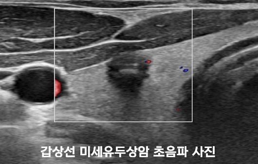 갑상선 초음파 물혹 검사받고 일상에서 관리하기