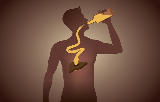 알코올은 지방간염을 일으켜 간경변, 간암에 이르게 한다