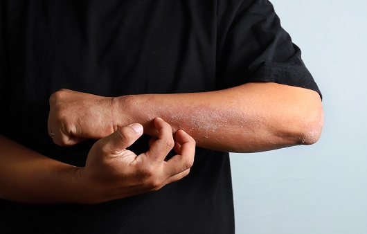 고치기 어려운 피부질환 ‘아토피’, 재발을 막으려면?