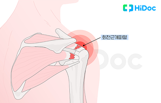 회전근개 파열