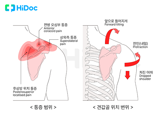 sick 견갑 증후군