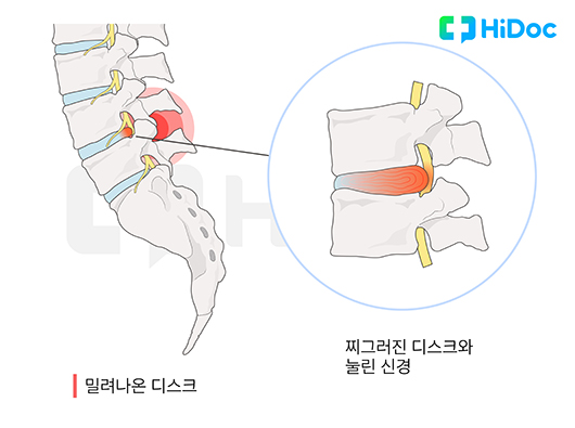 추간판탈출