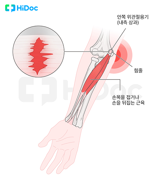 골프엘보