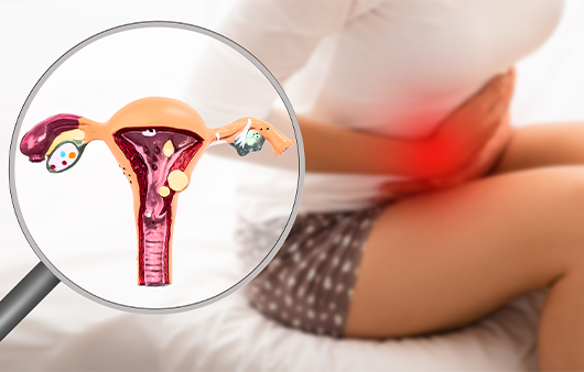 ‘자궁선근증’의 치료와 관리 방법