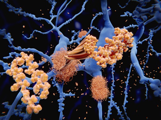 이상 단백질이 축적된 알츠하이머병 환자의 뇌