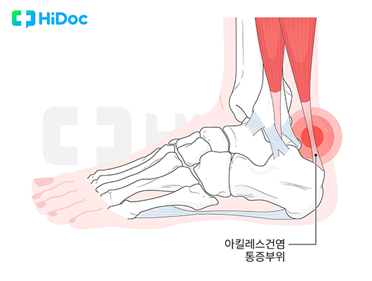 아킬레스건염ㅣ출처: 하이닥