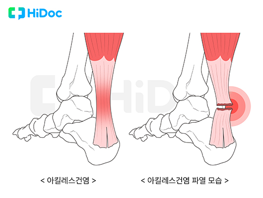 아킬레스건 파열ㅣ출처: 하이닥