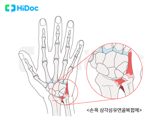 삼각 섬유 연골 복합체 손상 | 출처: 하이닥