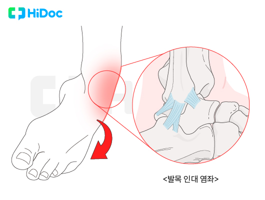 발목 염좌 | 출처: 하이닥
