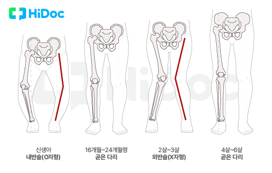 다리 성장 과정｜출처: 하이닥