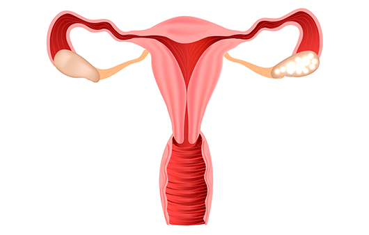 장기간의 생리불순, 무월경…‘다낭성 난소 증후군’ 의심해야