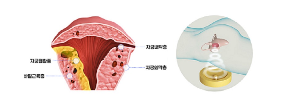 자궁선근증으로 자궁내막, 근육층 경계가 모호해지고 자궁이 비대해진 모습(좌)과 비수술치료 ‘하이푸’ 시술(우)｜제공: 최상산부인과의원