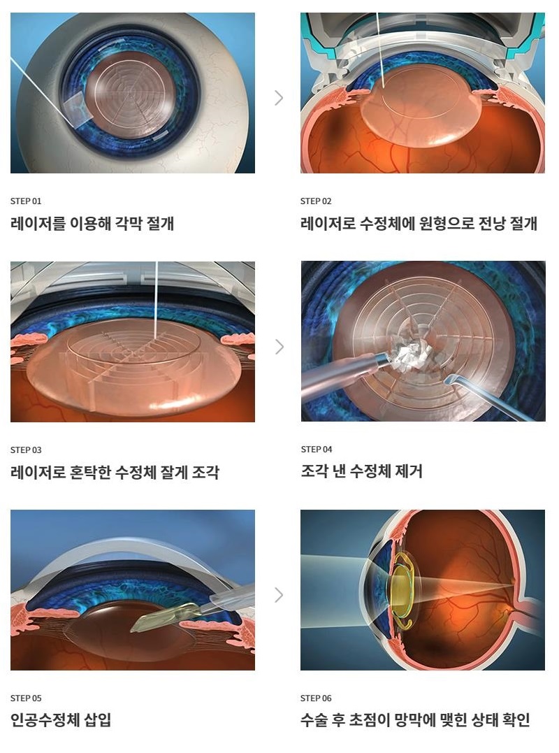 [금촌우리동물메디컬센터] 강아지/강아지 백내장 증상과 단계, 백내장 수술 인공렌즈 삽입진료 케이스