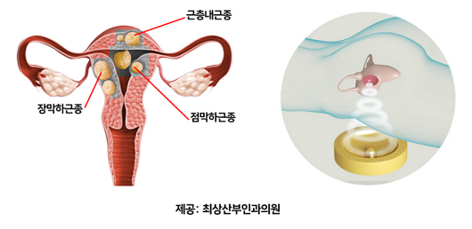 위치별 자궁근종 종류(좌측)와 고강도 집속초음파 하이푸 시술 이미지(우측)｜출처: 최상산부인과의원