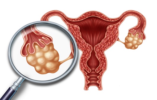 ‘난소낭종’과 ‘자궁내막종’, 사전 검사 통해 적절한 치료법 선택해야