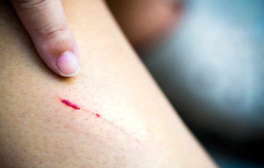 What happens when “tetanus” enters an unexpected wound