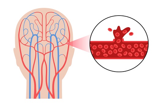 뇌출혈ㅣ출처: 게티이미지 뱅크