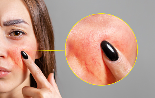 지루성피부염은 안면홍조와 같이 발생하는 경향이 있다ㅣ출처: 게티이미지뱅크