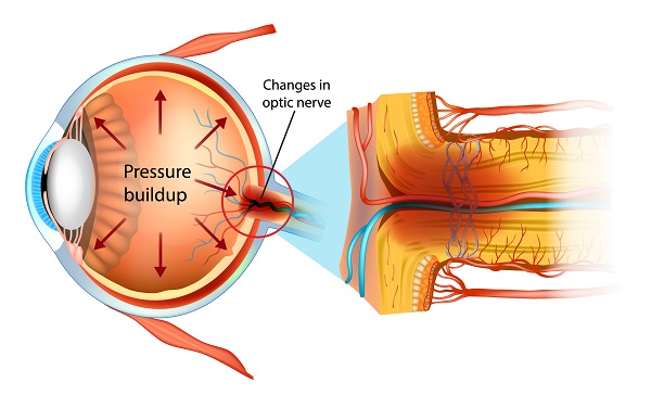 안압이 상승하면, 안구의 뒷부분을 지나 뇌로 이어진 시신경이 손상된다ㅣ출처: 게티이미지뱅크