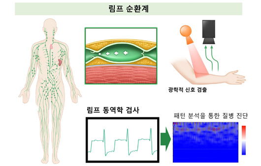 림프 동역학 검사ㅣ출처: 서울아산병원