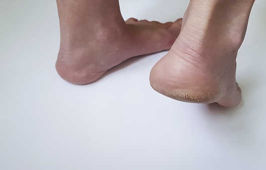 피부의 경질 및 과각질화는 흔히 발뒤꿈치, 엄지발가락의 측면 등에 쉽게 발생한다｜출처: 게티이미지뱅크