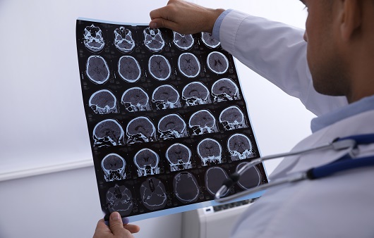 뇌수두증은 뇌 손상을 야기할 수 있다ㅣ출처: 게티이미지뱅크