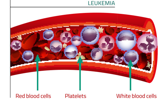백혈병은 골수의 정상 혈액 세포가 암세포로 변해 발생하는 혈액암이다ㅣ출처: 게티이미지뱅크