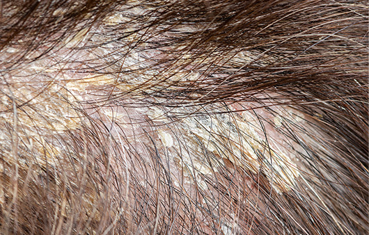 지루성 피부염이 두피에 생기면 노란색 딱지들이 머리를 뒤덮기도 한다ㅣ출처: 게티이미지뱅크