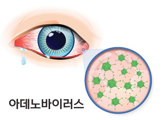 아데노바이러스가 눈에 침범하면 유행성 눈병이 나타난다ㅣ출처: 게티이미지뱅크