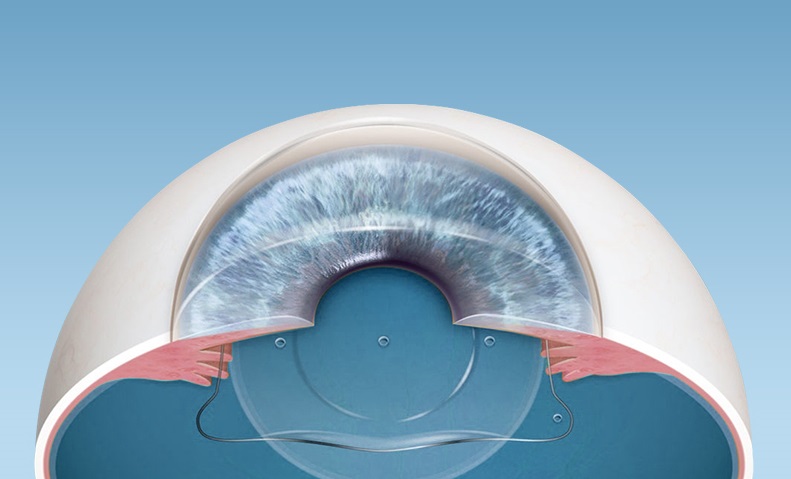 후방렌즈삽입술에 사용되는 EVO+ICLㅣ출처:비앤빛강남밝은세상안과