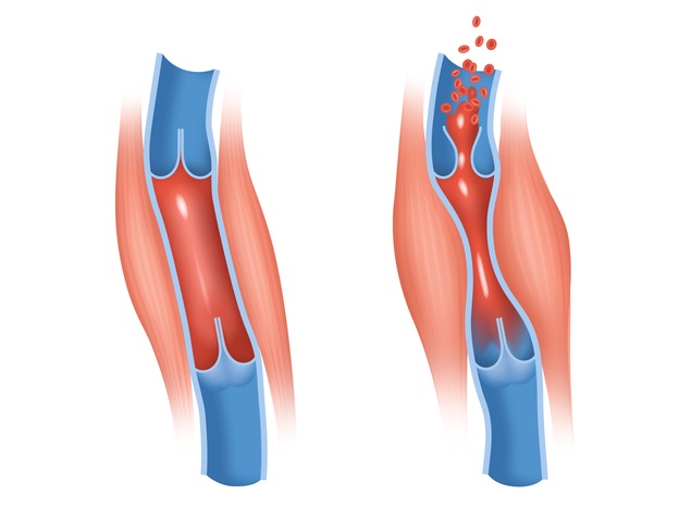 정맥 혈액이 심장 쪽으로 올라가려면 종아리 근육의 수축·이완 운동이 필요하다ㅣ출처: 게티이미지뱅크
