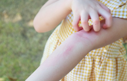 Scarlet fever, a highly contagious disease mainly affecting children under 10, has reemerged in recent years. Prevention is through hygiene management.