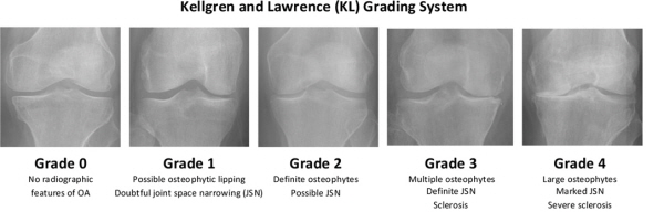 켈그렌-로렌스 분류법｜출처: fully automatic knee osteoarthritis severity grading using deep neural networks with a novel ordinal loss pubilsed in europe pmc by