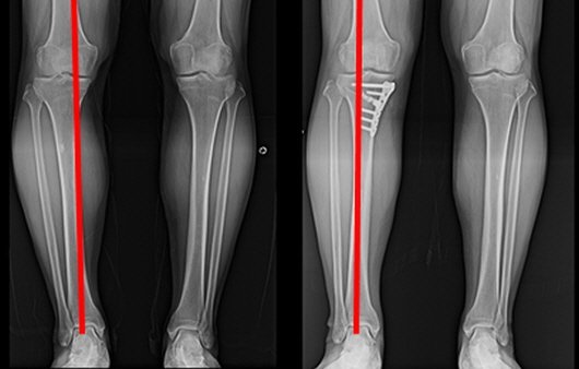 좌 : 수술 전 오다리(내반슬) 상태 / 우 : 오다리 교정술 (근위 경골 절골술) 시행. 수술 후 체중 부하 선이 무릎의 안쪽에서 바깥쪽으로 이동한 것을 확인할 수 있다 l 출처: 마디세상병원