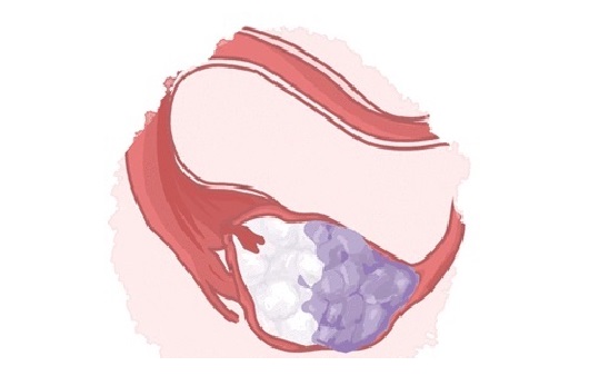 난소에 형성된 자궁내막증(자궁내막종)ㅣ출처: 이해와공감 산부인과의원