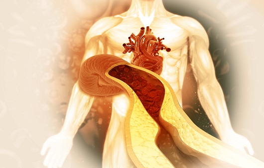최근 ldl 콜레스테롤 수치가 낮아도 심혈관질환의 위험이 높아진다는 역설적인 연구 결과가 나왔다｜출처: 게티이미지뱅크
