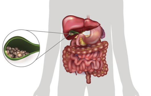 담낭에 담석이 생기면 담낭염이 발생할 수 있다ㅣ출처 : 게티이미지뱅크