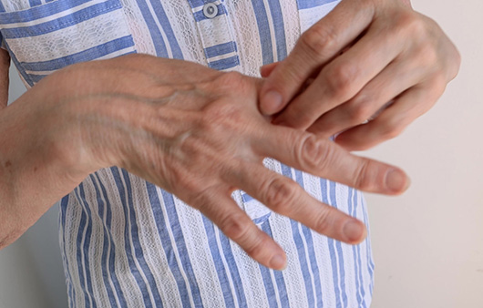 피부 기생충 감염질환인 옴에 감염되면 손가락 사이, 손목 관절 부위 등이 가려운 증상이 나타난다ㅣ출처: 게티이미지뱅크