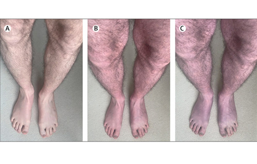 새로운 롱코비드 증상인 푸른 다리 증후군 환자 사례 | 출처 : 국제 학술지 란셋(the lancet)