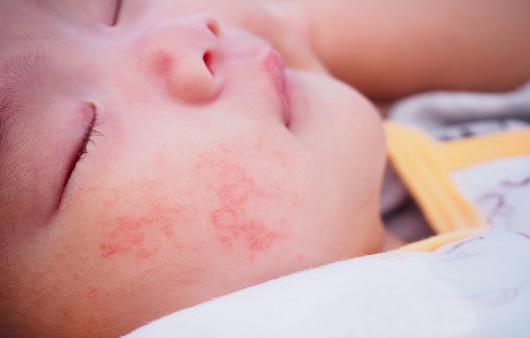 아토피 피부염은 주로 영유아기에 시작된다ㅣ출처: 게티이미지뱅크