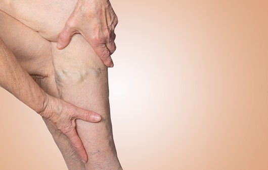 하지정맥류의 대표 증상은 다리가 무겁거나 피로한 느낌이다ㅣ출처: 게티이미지뱅크