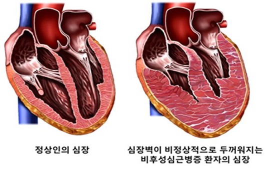 비후성 심근증 환자의 심혈관계 합병증 위험을 보다 정확하게 예측할 수 있는 지표가 제시됐다｜출처: 서울대학교병원