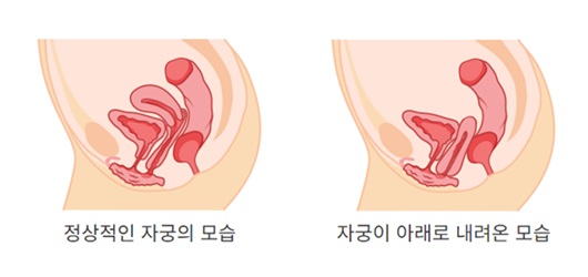 정상 자궁 대비 자궁이 아래로 내려온 모습｜ 출처: 최상산부인과