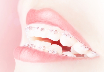 치아교정에 대한 Q&A (1) 교정하면 치아가 약해진다?